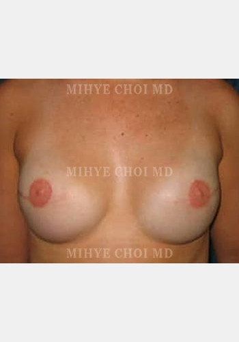 After Image: Implant Breast Reconstruction – Case 2 - front