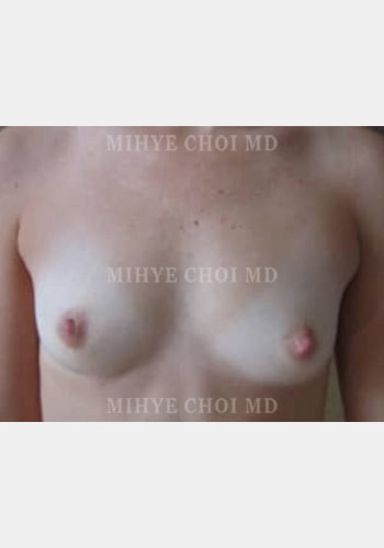 Before Image: Implant Breast Reconstruction – Case 2 - front