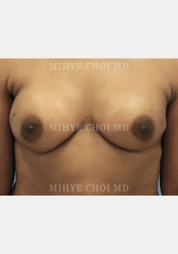 Implant Breast Reconstruction – Case 3