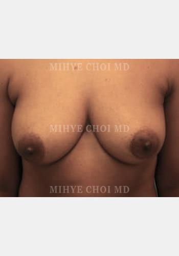 Before Image: Implant Breast Reconstruction – Case 3 - front