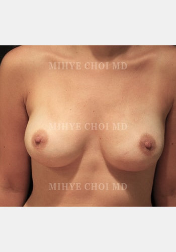 After Image: Implant Breast Reconstruction – Case 4 - front