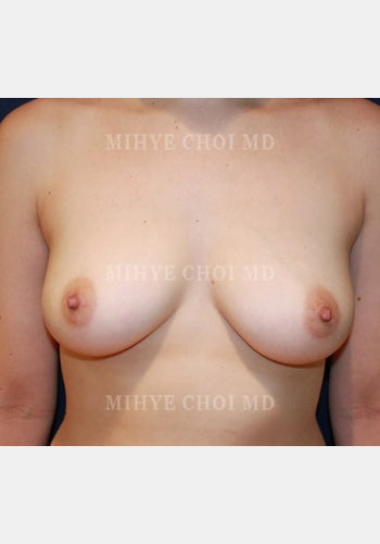 Before Image: Implant Breast Reconstruction – Case 4 - front