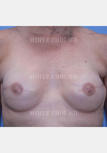 After Image: Implant Breast Reconstruction – Case 5 - front