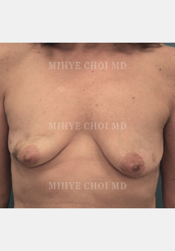 Implant Breast Reconstruction – Case 5