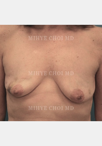 Before Image: Implant Breast Reconstruction – Case 5 - front