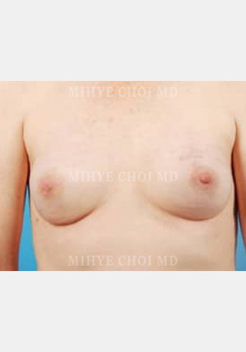 After Image: Implant Breast Reconstruction – Case 6 - front