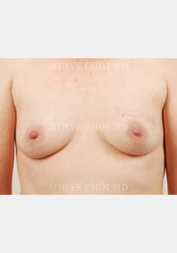 Before Image: Implant Breast Reconstruction – Case 6 - front