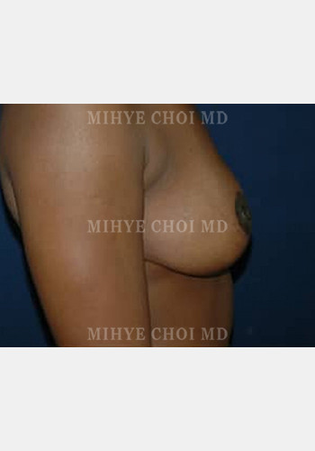 After Image: Mastopexy – Case 1 - other
