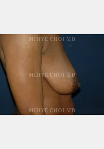 Before Image: Mastopexy – Case 1 - other