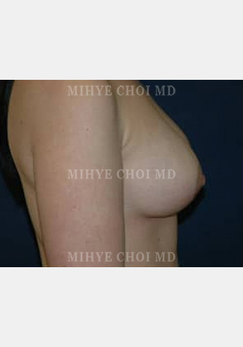 After Image: Mastopexy – Case 2 - other