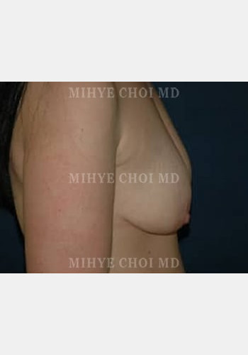 Before Image: Mastopexy – Case 2 - other
