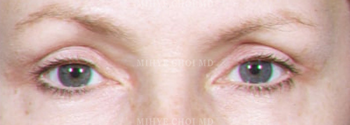 Blepharoplasty – Case 1