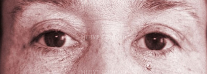 Blepharoplasty – Case 2