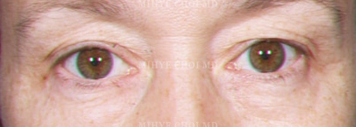 Before Image: Blepharoplasty – Case 2 - other