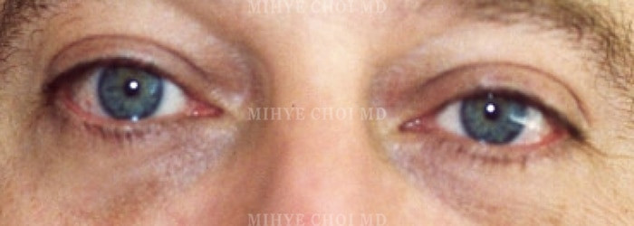 After Image: Blepharoplasty – Case 3 - other