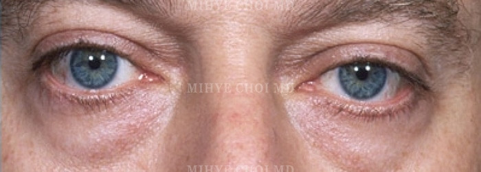 Before Image: Blepharoplasty – Case 3 - other
