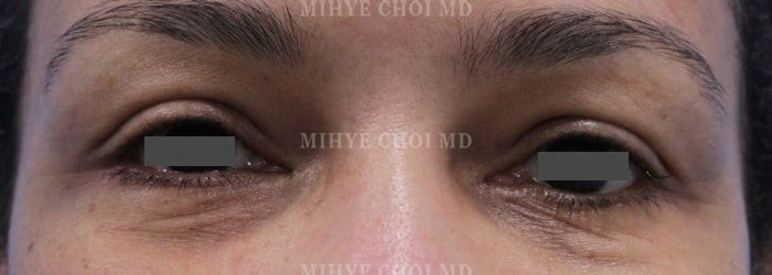 After Image: Blepharoplasty – Case 4 - other