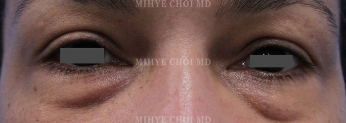 Before Image: Blepharoplasty – Case 4 - other