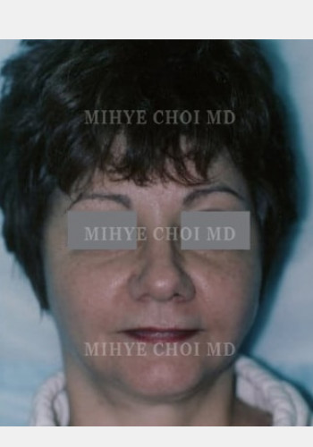 After Image: Facelift – Case 1 - front