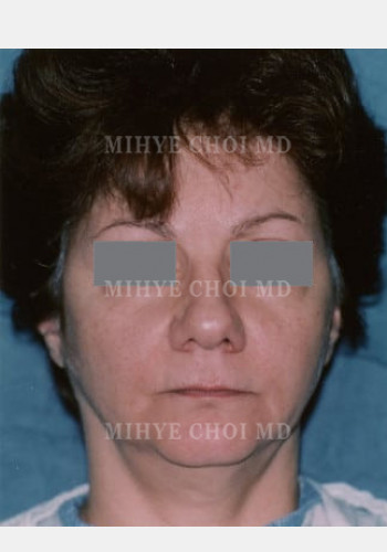 Before Image: Facelift – Case 1 - front