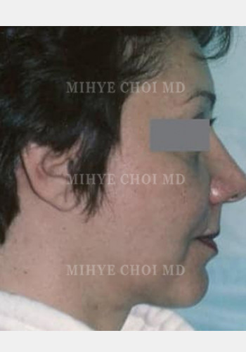 After Image: Facelift – Case 1 - other