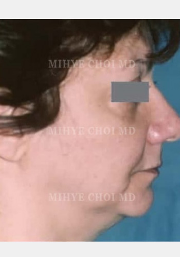 Before Image: Facelift – Case 1 - other