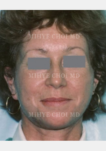 After Image: Facelift – Case 2 - front