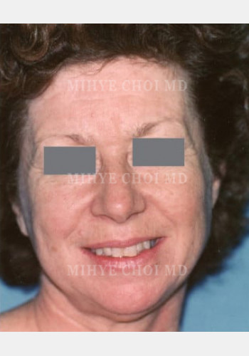 Before Image: Facelift – Case 2 - front