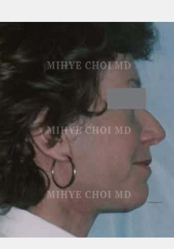 After Image: Facelift – Case 2 - other