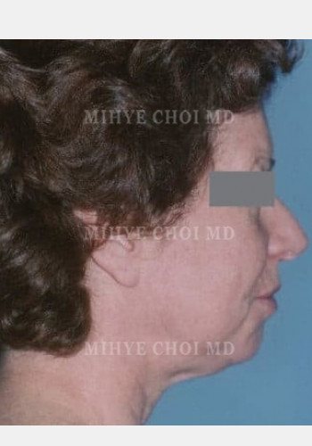 Before Image: Facelift – Case 2 - other