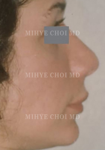 After Image: Rhinoplasty – Case 3 - other