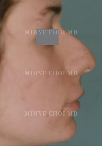 Before Image: Rhinoplasty – Case 3 - other