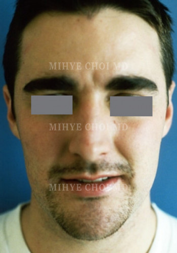 After Image: Rhinoplasty – Case 2 - front