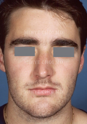 Before Image: Rhinoplasty – Case 2 - front