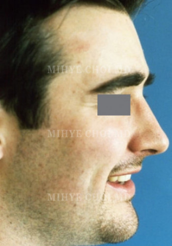 After Image: Rhinoplasty – Case 2 - other