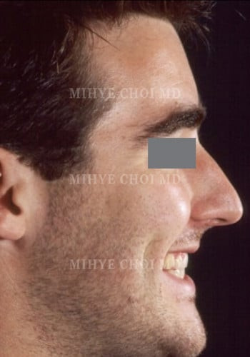 Before Image: Rhinoplasty – Case 2 - other