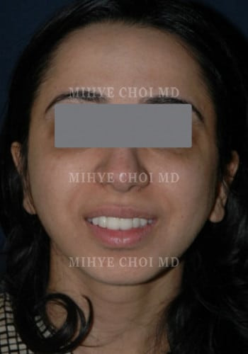 After Image: Rhinoplasty – Case 1 - front