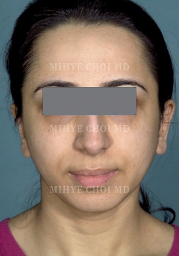 Before Image: Rhinoplasty – Case 1 - front