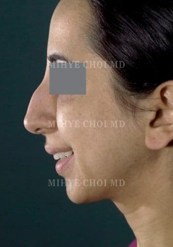 Before Image: Rhinoplasty – Case 1 - other