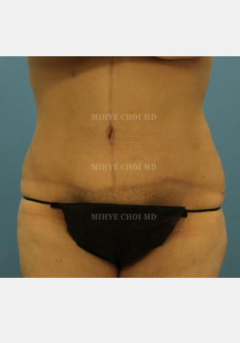 After Image: Massive Weight Loss Surgery – Case 3 - front