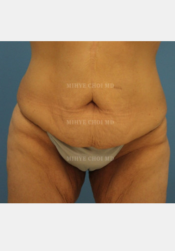 Before Image: Massive Weight Loss Surgery – Case 3 - front