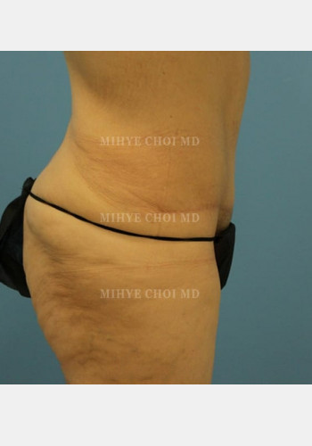 After Image: Massive Weight Loss Surgery – Case 3 - other