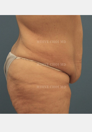Before Image: Massive Weight Loss Surgery – Case 3 - other