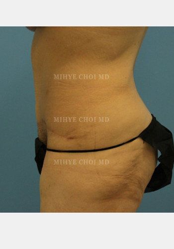 After Image: Massive Weight Loss Surgery – Case 3 - other
