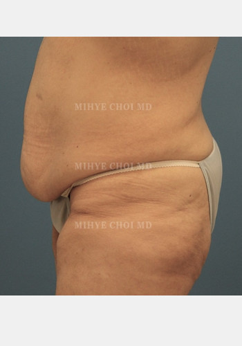 Before Image: Massive Weight Loss Surgery – Case 3 - other