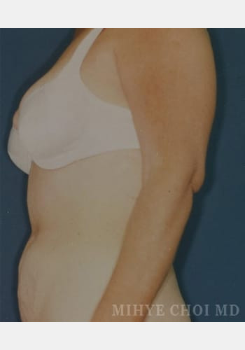 After Image: Abdominal Liposuction Case 4 - front