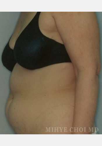 Before Image: Abdominal Liposuction Case 4 - front